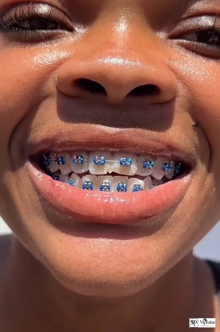 Teeth braces